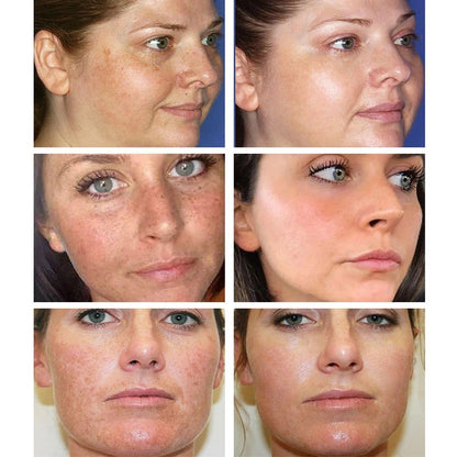 [Official Store] Bloobeac® Blemish Removing Beauty Cream – Fades Dark Spots, Freckles & Wrinkles | Age-Defying, Even-Tone Treatment