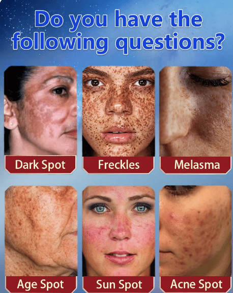 [Official Store] Bloobeac® Blemish Removing Beauty Cream – Fades Dark Spots, Freckles & Wrinkles | Age-Defying, Even-Tone Treatment